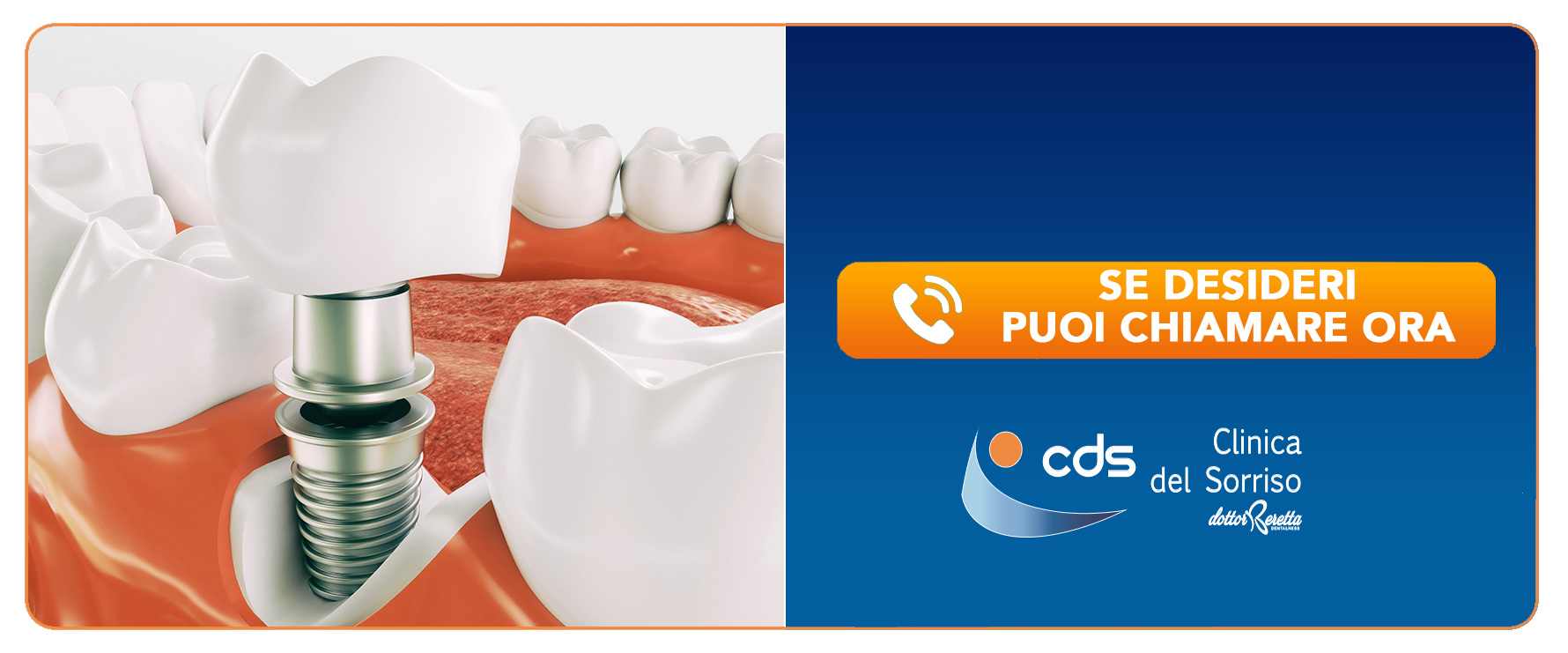 implantologia-semplice-o-dente-singolo Torreglia Padova